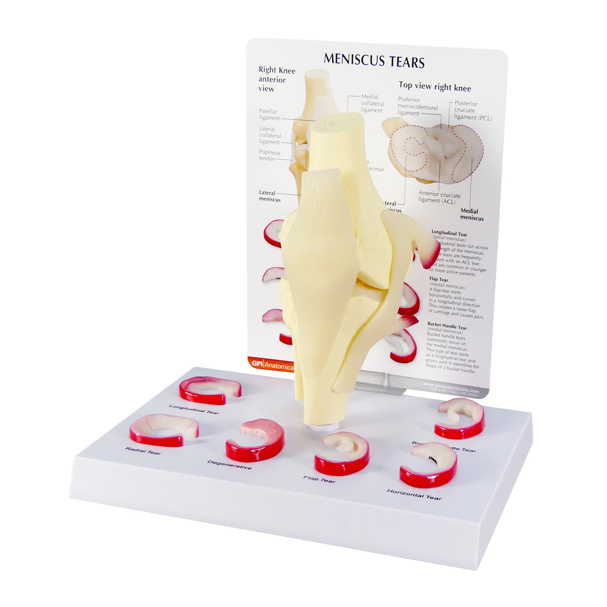 Meniscus Modeled Model - Meniscus Tears (6 Tears)