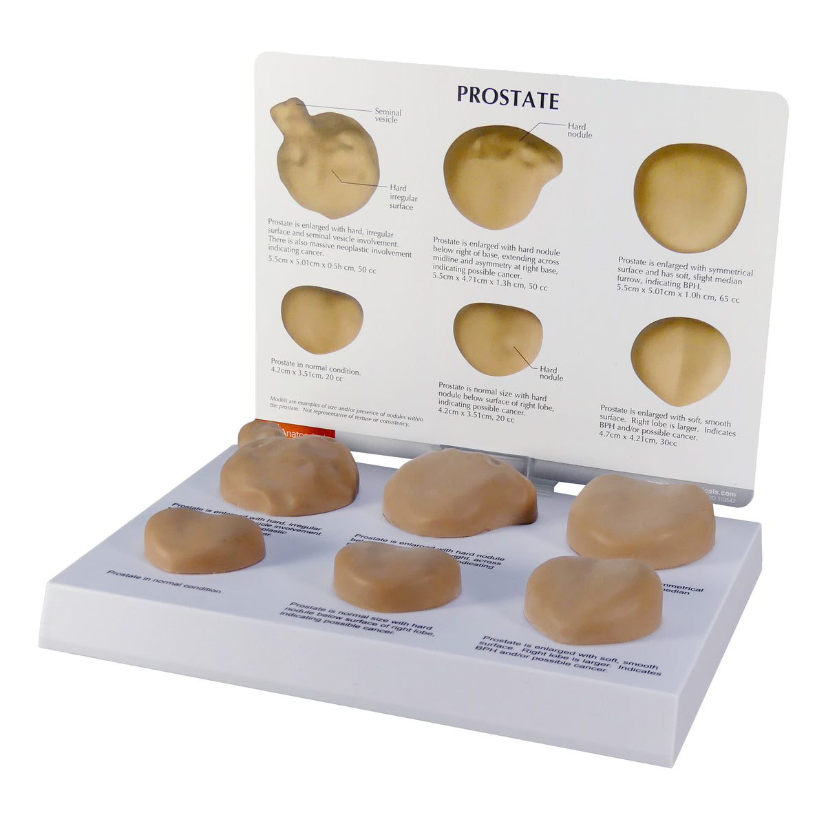 Model - Prostate Set