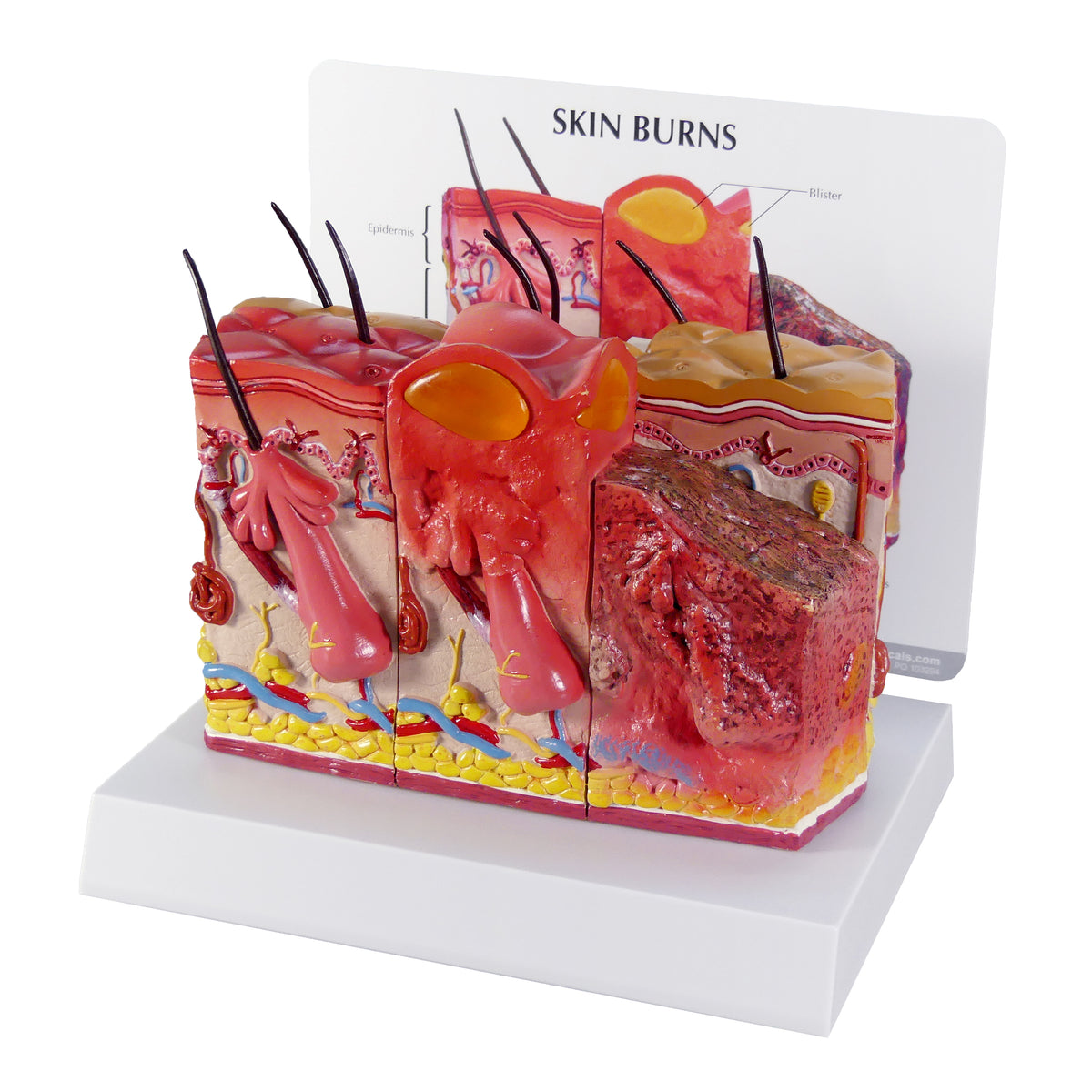 Brazen Skin Example Model - Skin Burn & Normal Skin (2-Sided) – Biology Products