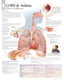 Chart - Atrial Fibrillation & Ischemic Stroke