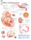 Chart - Effects of Hypertension