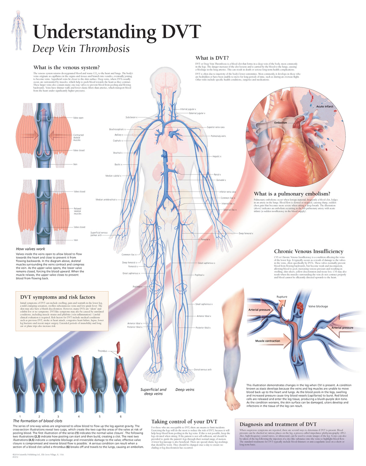 Dvt Key Signs Chart - Understanding DVT