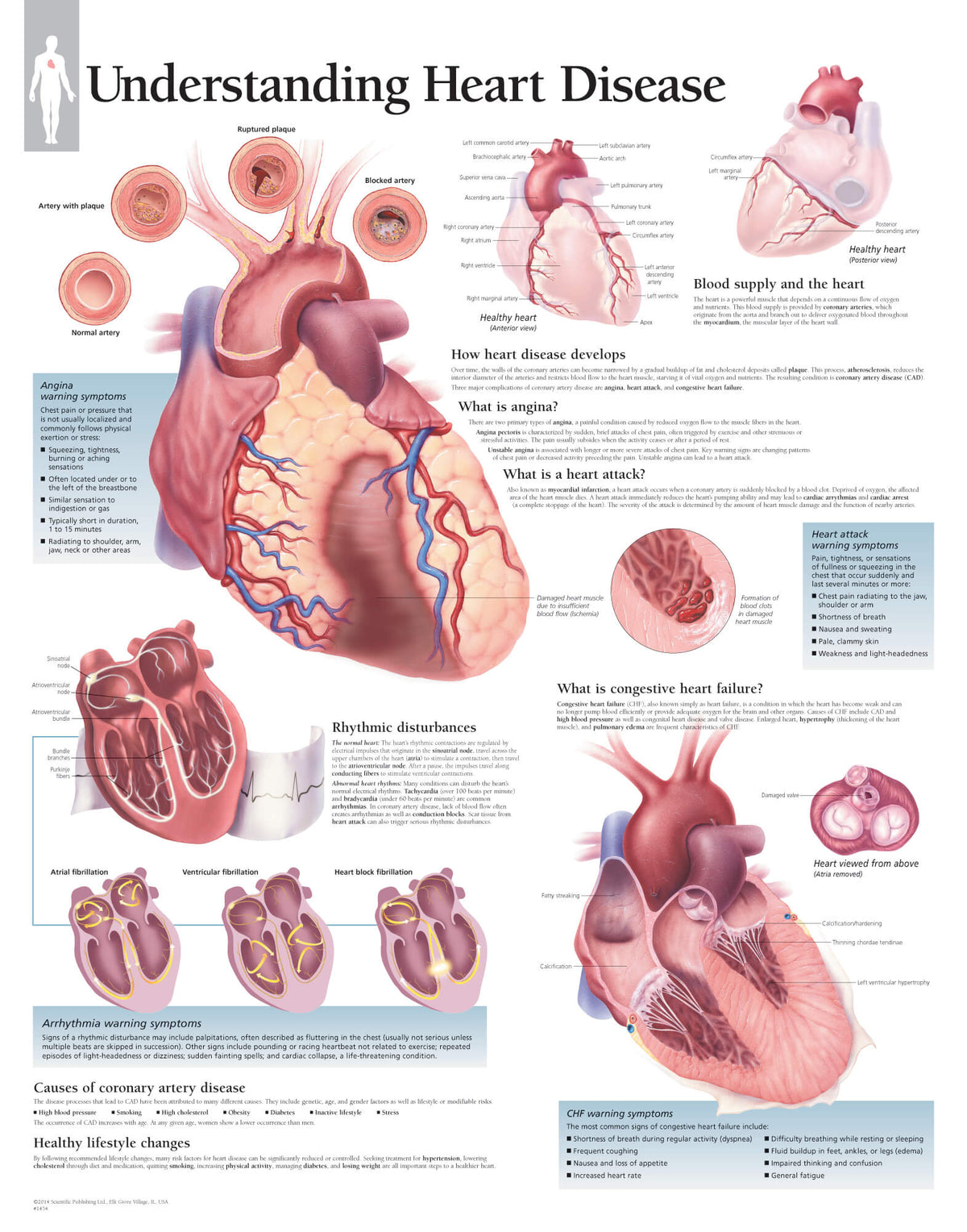 Chart - Understanding Heart Disease