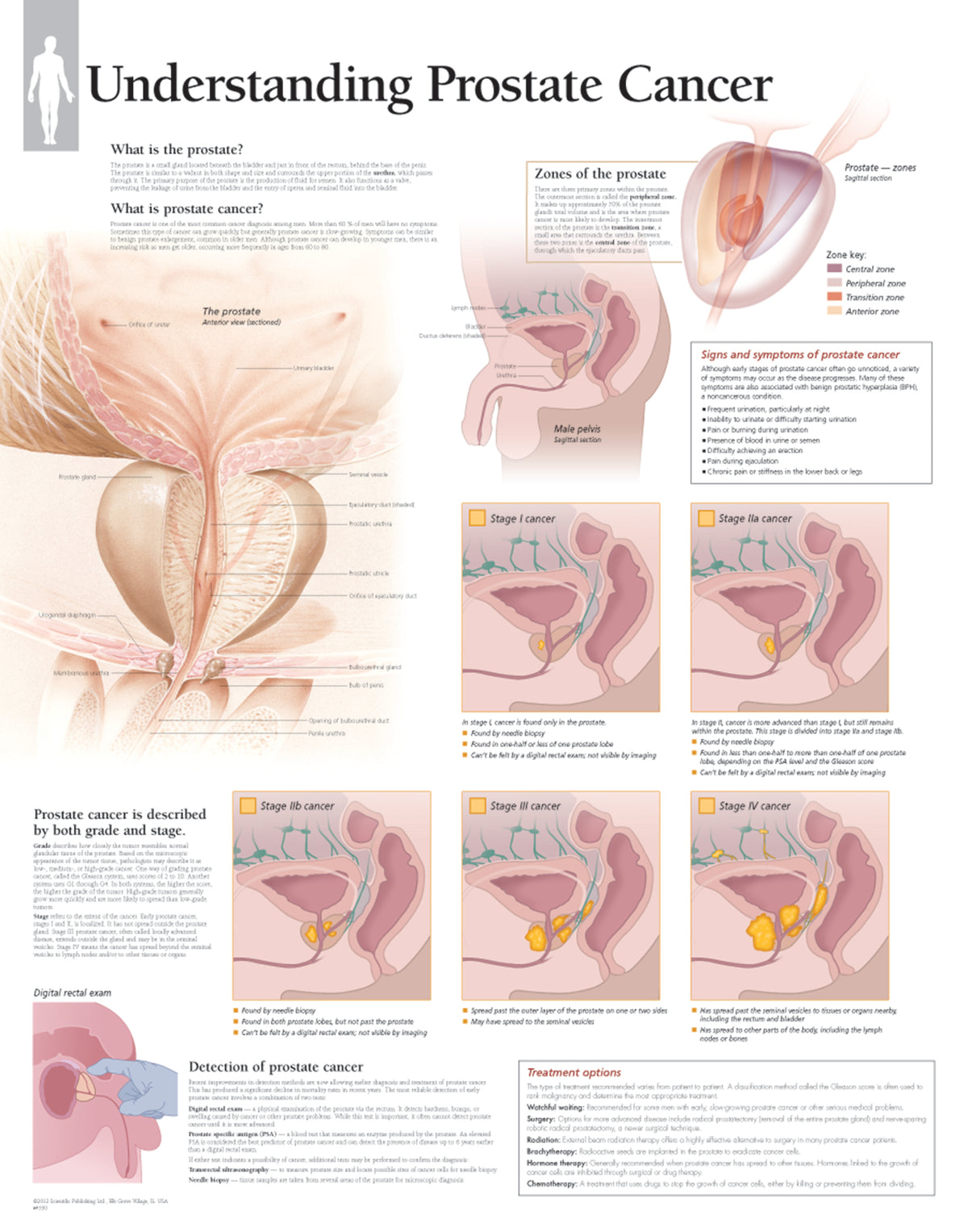 Chart - Understanding Prostate Cancer