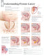 Chart - Understanding Prostate Cancer