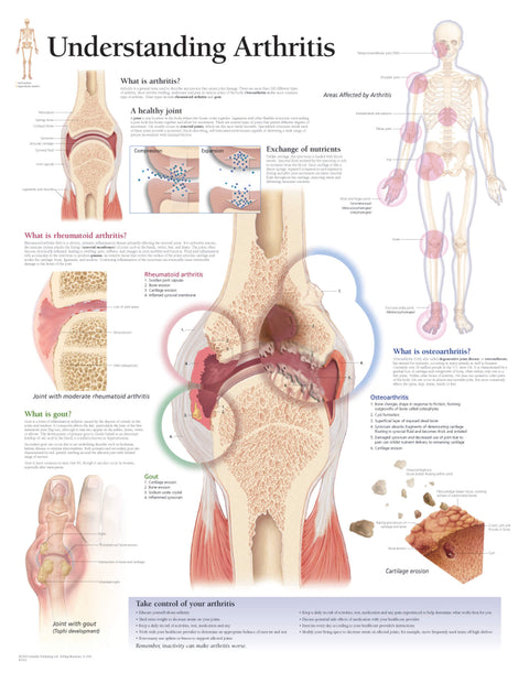 Replacement Pads - Understanding Arthritis Replacement Pads for Study