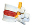 Prolapsed Intervertebral Disc