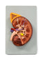 Enlarged Kidney Model